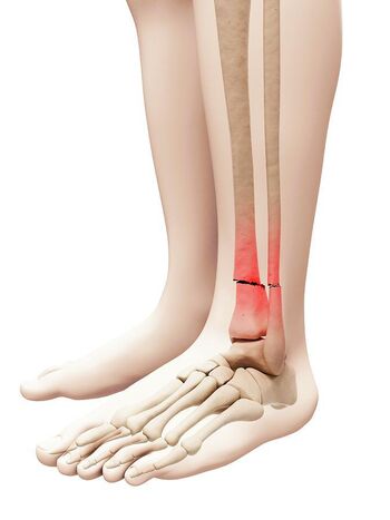 brokenleg